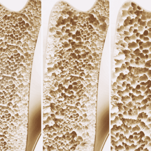 Lees verder en ontdek welke hulpmiddelen jou bij botontkalking kunnen ondersteunen. Lees verder en ontdek welke hulpmiddelen jou bij botontkalking kunnen ondersteunen.
